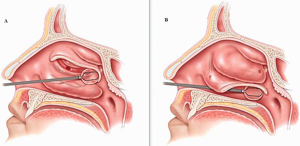 後鼻神經位置與鼻過敏相關解剖示意圖