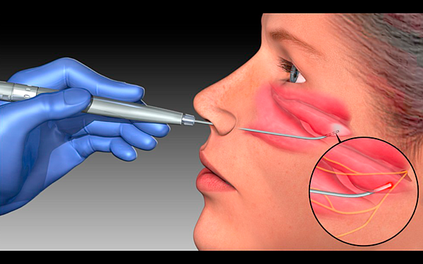 微創內視鏡後鼻神經阻斷術操作步驟示意圖
