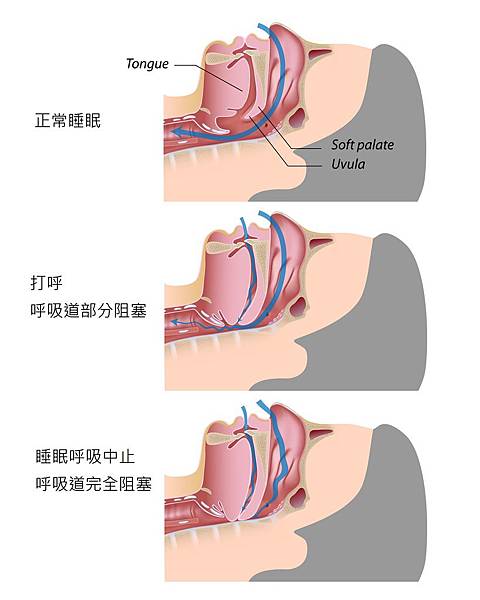 打呼與睡眠呼吸中止症示意圖