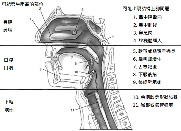 打呼與睡眠呼吸中止症示意圖